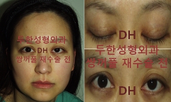[Ptosis, Duhan Plastic Surgery] - [Sleepy-Looking Eyes, Ptosis Eye Correction] image 26