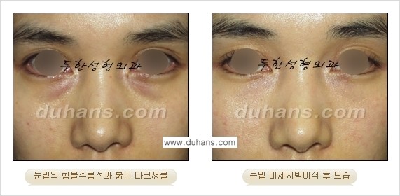 [두한성형외과 경쟁력 미세지방이식] - [다크써클 & 눈밑주름 미세지방이식 3.] 관련 이미지 11
