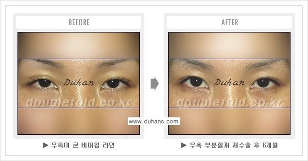 [두한성형외과 경쟁력 쌍꺼풀 재수술(극한 재수술)] - [피부 여유분이 부족해서 토안증이 발생한 경우의 문제점 해결 안내] 관련 이미지 5