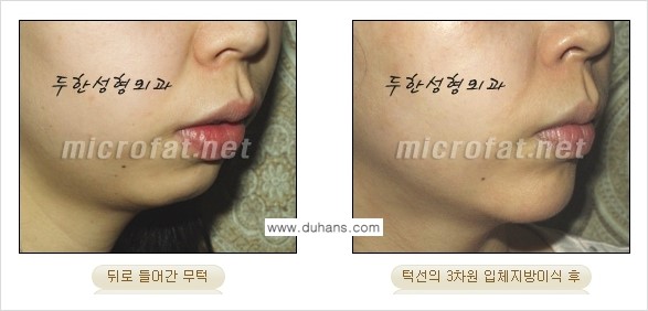 [두한성형외과 경쟁력 미세지방이식] - [얼굴 윤곽 무턱교정 안내 ②] 관련 이미지 10