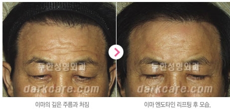 Duhan Plastic Surgery Combo Program - Dark Circles and Lifting image 25