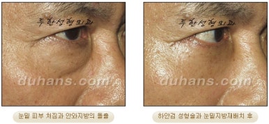 Blepharoplasty, Duhan Plastic Surgery - Upper and Lower Eyelids image 35