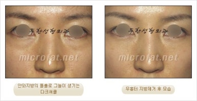 두한성형외과 눈밑수술 - 다크서클 수술 전후 관리 안내 관련 이미지 64