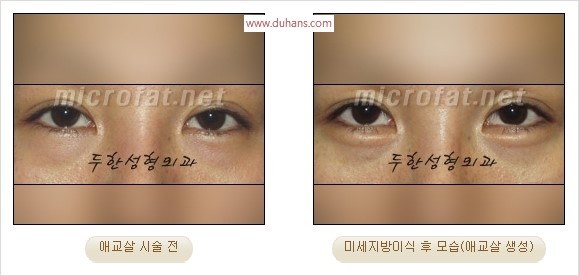 ​﻿[두한성형외과 경쟁력 지방이식] - [눈밑 애교살 시술을 위한 미세지방이식] 관련 이미지 42