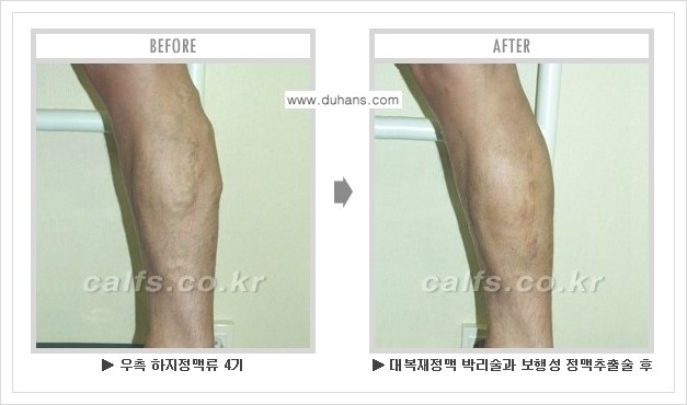 [두한성형외과 경쟁력 멀티종아리성형] - [하지정맥류 치료 안내] 관련 이미지 5