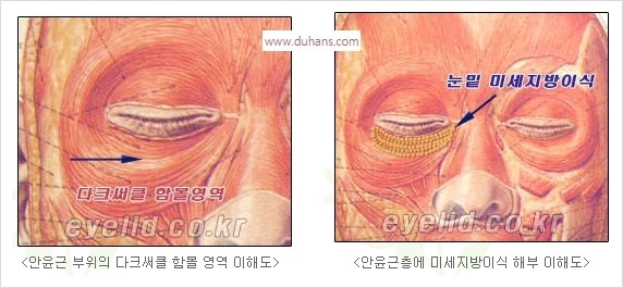[두한성형외과 경쟁력 눈밑성형] - [눈밑 다크써클 수술 방법] 관련 이미지 10