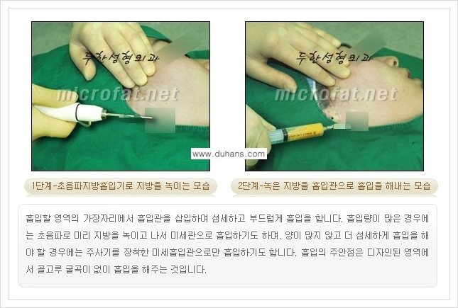 [두한성형외과 경쟁력 얼굴지방흡입] - [통통한 볼살, 두툼한 턱살(턱선)의 지방흡입] 관련 이미지 9