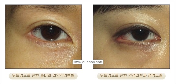 [두한성형외과 경쟁력 쌍꺼풀 재수술, 극한 눈재수술] - [뒤트임 수술의 부작용 안내] 관련 이미지 8