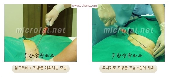 [두한성형외과 경쟁력 안면윤곽 교정] - [자연스럽고 균형있는 턱으로의 복원 미세지방이식과 간편 사각턱 보톡스 안내] 관련 이미지 8