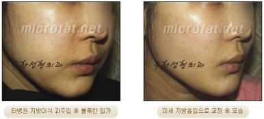 [두한성형외과 얼굴지방이식] - [볼지방이식] 관련 이미지 42