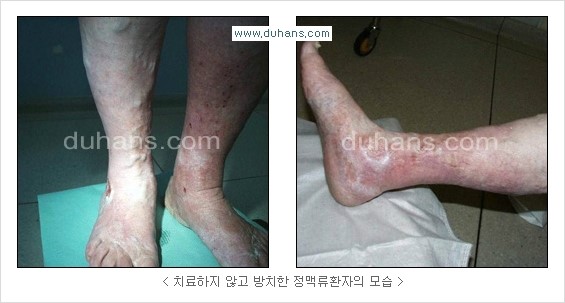 [두한성형외과 경쟁력 정맥류 치료] - [정맥류와 정맥확장증의 문제점 안내] 관련 이미지 2