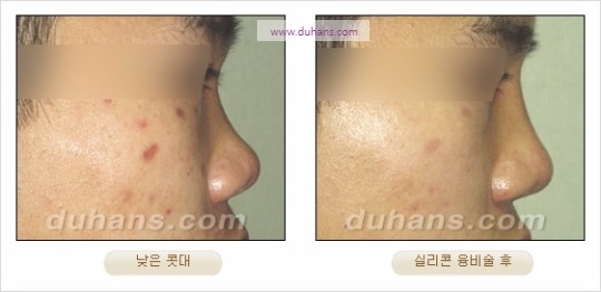 [두한성형외과 경쟁력 코성형 리더] - [자연스럽고 오똑한 콧망울! 코성형 방법]​ 관련 이미지 13