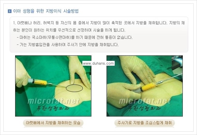 [두한성형외과 경쟁력 미세지방이식] - [부드럽고 아름다운 얼굴 윤곽선 이마(전두부) 미세지방이식] 관련 이미지 4