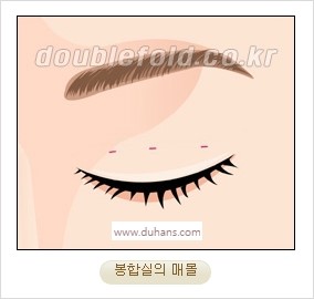 [두한성형외과 경쟁력 눈성형] - [자연스럽고 아름다운 눈매를 만드는 여러 가지 눈성형 방법] 관련 이미지 12