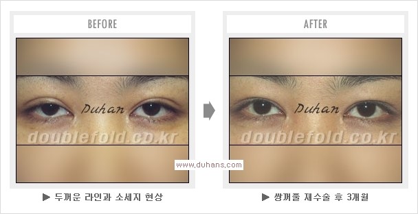 [두한성형외과 경쟁력 눈성형] - [쌍꺼풀 재수술 과정과 쌍꺼풀 재수술 실패의 원인, 쌍꺼풀 재수술의 성공 요건] 관련 이미지 11