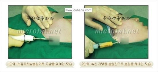 [두한성형외과 경쟁력 자가지방이식] - [지방이식 부작용의 종류와 교정방법] 관련 이미지 3