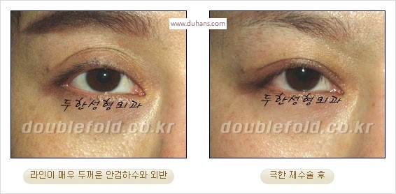 [두한성형외과 경쟁력 쌍꺼풀 재수술 스페셜] - [망가진 라인을 교정하는 극한 재수술] 관련 이미지 26