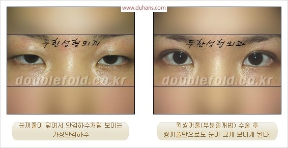 [두한성형외과 경쟁력 눈성형] - [극한 재수술, 함몰된 눈꺼풀 라인교정, 안검하수(졸리운 눈매)] 관련 이미지 96