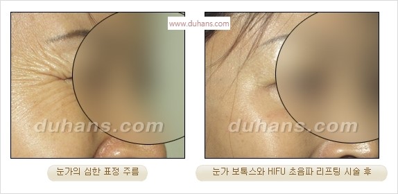 [두한성형외과 경쟁력 주름성형] - [주름제거를 위한 리프팅] 관련 이미지 53