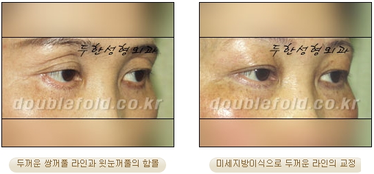 [Duhan Plastic Surgery Double Eyelid Revision Surgery] - [Correcting the Double Eyelid Line in Sunken Eyelids] image 24