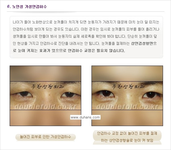 [두한성형외과 NO.1 "극한 눈(쌍꺼풀 재수술)"] - [안검하수(졸린눈매) 재수술 안내 1.] 관련 이미지 9