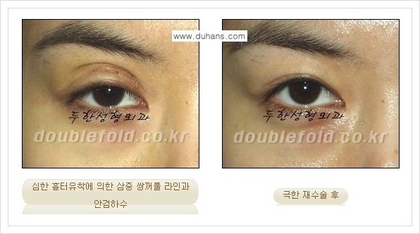 [두한성형외과 경쟁력 눈성형] - [극한의 망가진 쌍꺼풀 복원수술과 일반 쌍꺼풀 재수술과의 차이점 안내] 관련 이미지 3