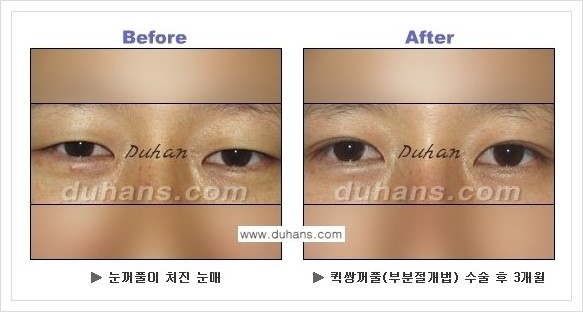 [두한성형외과 경쟁력 눈성형] - [퀵쌍꺼풀 수술 전후 정보 안내 ②] 관련 이미지 11