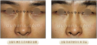 두한성형외과 눈밑성형 - 눈밑지방제거, 눈밑주름, 눈밑지방재배치 관련 이미지 73