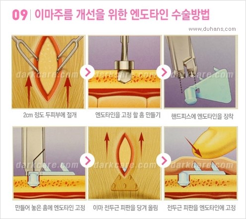 [두한성형외과 경쟁력 다크써클 치료] - [다크써클 + 엔도타인 리프팅 콤비 프로그램] 관련 이미지 10