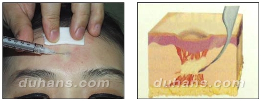 [DuHan Plastic Surgery Scar] - [DHL Simple Scar Treatment] image 5