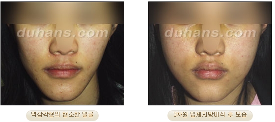 [두한성형외과 얼굴자가지방이식] - [볼살, 이마, 측두부] 관련 이미지 15