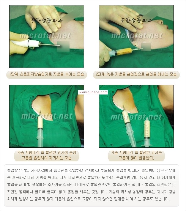 [두한성형외과 경쟁력 미세지방이식] - [타병원에서의 미세지방이식 이후 부작용 교정의 대상 안내] 관련 이미지 14