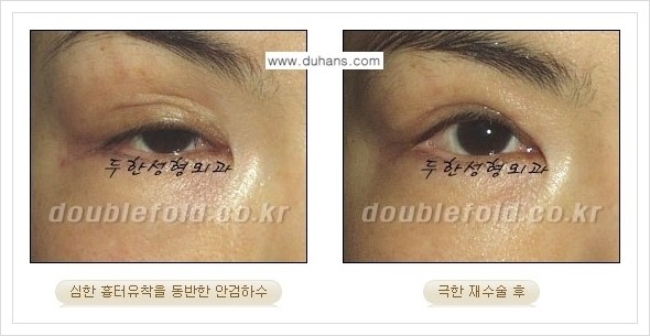 [두한성형외과 경쟁력 쌍꺼풀 재수술] - [극한의 상태에서 쌍꺼풀 재수술 안내 ②] 관련 이미지 8
