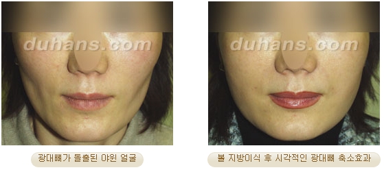 [두한성형외과 얼굴자가지방이식] - [볼살, 이마, 측두부] 관련 이미지 18