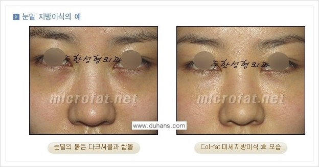[두한성형외과 경쟁력 눈밑성형] - [눈밑 다크써클, 눈밑 주름의 교정 안내 2.] 관련 이미지 1