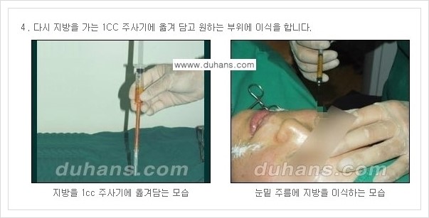 ​[두한성형외과 경쟁력 주름성형] - [주름교정을 위한 미세지방이식 안내 1.] 관련 이미지 10