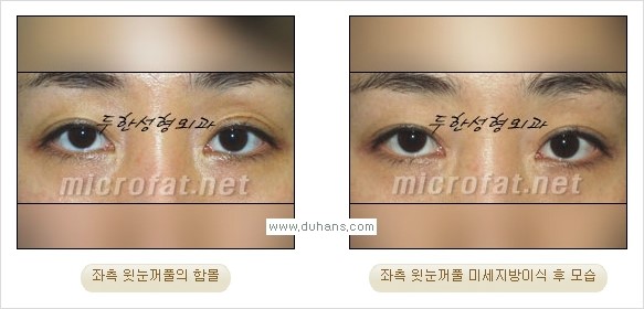 [두한성형외과 경쟁력 미세지방이식] - [꺼진(함몰된) 윗눈꺼풀 미세지방이식] 관련 이미지 19