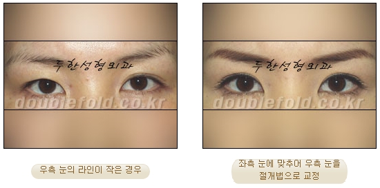 [Duhan Plastic Surgery Eye Surgery] - [Asymmetric Line, Eyelash Eversion, Deep Fixation] image 3