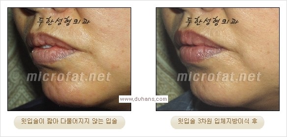 [두한성형외과 경쟁력 미세지방이식] - [입술 3차원 입체지방이식 안내 2.] 관련 이미지 12