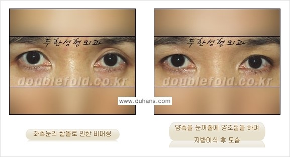 [두한성형외과 경쟁력 눈성형] - [미세지방이식으로 비대칭 쌍꺼풀 라인의 교정 방법 안내] 관련 이미지 5
