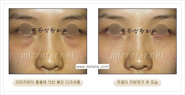 [두한성형외과 경쟁력 눈밑성형] - [눈밑지방제거, 눈위지방제거 안내 2.] 관련 이미지 6