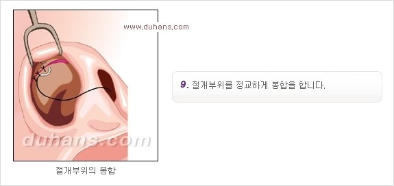 [두한성형외과 경쟁력 코성형] - [코성형을 위한 알로덤(슈어덤) 수술, 실리콘 수술 안내] 관련 이미지 26