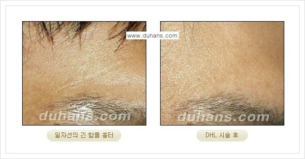 ​[두한성형외과 경쟁력 흉터성형] - [함몰흉터의 DHC 시술] 관련 이미지 5