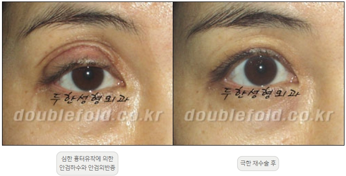 [Duhan Plastic Surgery Double Eyelid Revision] - [Thick Double Eyelid Line] image 38