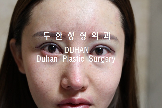 큰 아웃라인,#안검하수 #눈재수술, #애교살 #지방이식 관련 이미지 5
