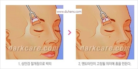 [두한성형외과 경쟁력 동안성형 리더] - ​[미간주름, 이마주름, 안검성형, 이마거상술, 눈썹거상술] 관련 이미지 126