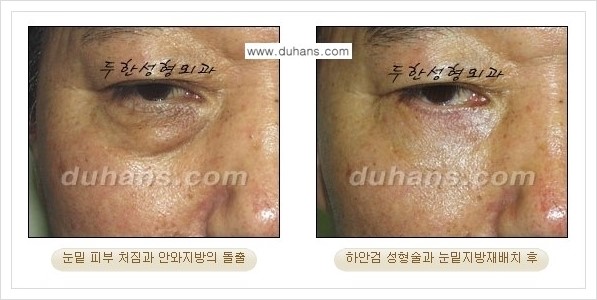 [두한성형외과 경쟁력 눈성형] - [젊은 눈매로의 복원 안검성형] 관련 이미지 27