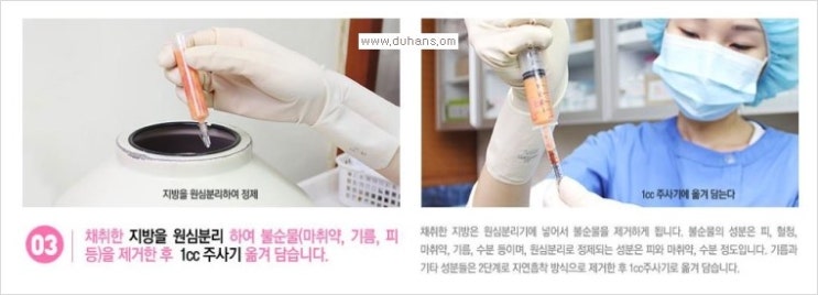 [두한성형외과 경쟁력 눈밑 다크써클 치료] - [눈밑 다크써클과 눈위 지방이식 콤비 프로그램 안내] 관련 이미지 7