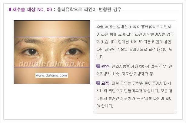⁠⁠[두한성형외과 경쟁력 쌍꺼풀 재수술, 극한 재수술] - [쌍꺼풀 재수술이 필요한 경우 안내] 관련 이미지 7