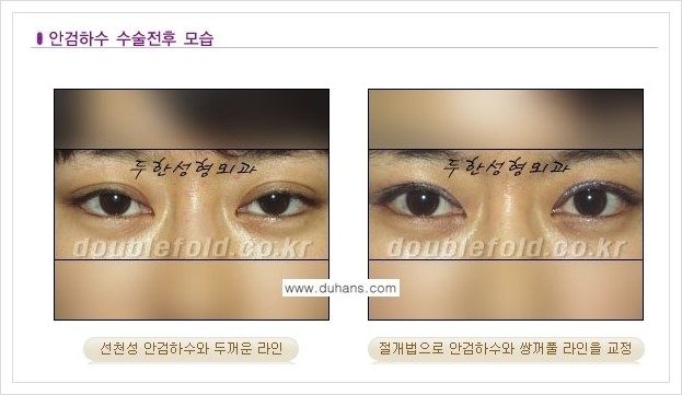 [두한성형외과 경쟁력 쌍꺼풀 재수술, 극한 재수술] - [안검하수(졸린눈매) 교정 방법 안내] 관련 이미지 1
